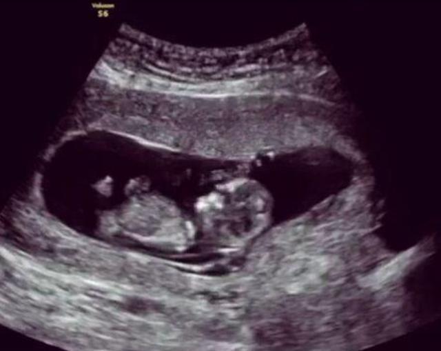 妻子|孕期38周却“胎死腹中”,这些“孕妇杀手”要预防,准爸妈得留意