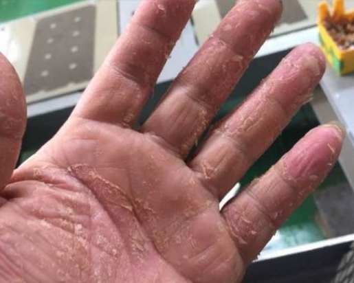 锯齿状|手掌有了“这个”,大多是“癌细胞”在向你招手,现在知道还不晚