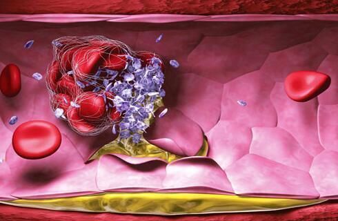 血管健康|身体这3个地方出现疼痛,可能是血栓发出的信号,还请及时就诊检查!