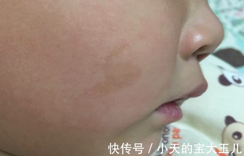 化妆品|婴儿身上为什么会有胎记？资深医生说出原因，与“孕期行为”有关