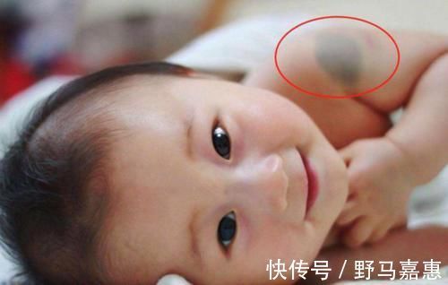 产科大夫|胎记是怎么来的?产科大夫:天生的除外,孕期这3种行为尽量避开