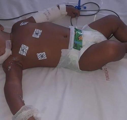 重症监护室|6个月宝宝将“电线”咬漏电，被电晕后又烧伤，父母发现后哭惨了