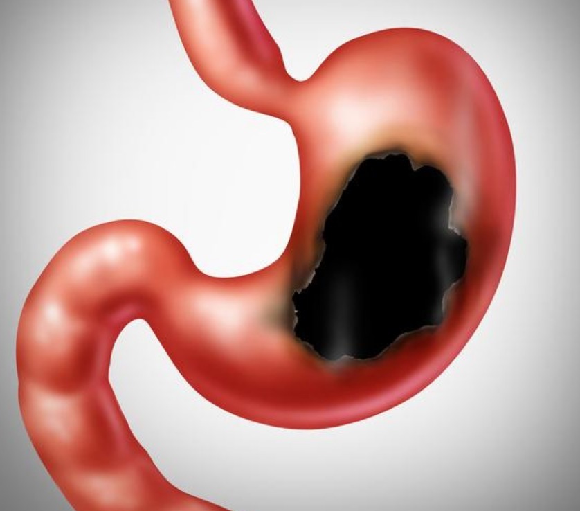 致癌物质|全球胃癌患者50中国人,营养专家呼吁3种食物要少碰