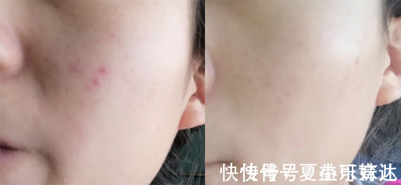 痘痘|已被拉入“黑名单”的护肤品,皮肤科医生都不敢用,孕妈还在囤?