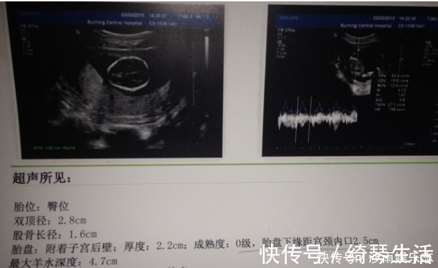 宝宝|孕期，孕妈做四维彩超若有这些信号，怀男孩的可能性大吗