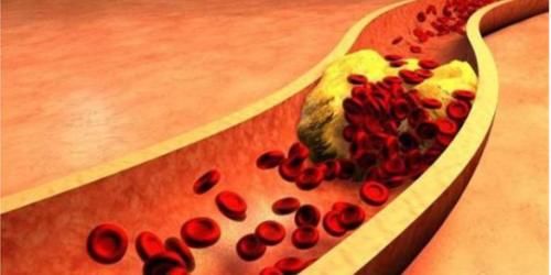 高血脂|高血脂的人,哪些食物要少吃?医生:2类食物,吃多了血脂会更高