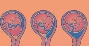 凶险性|分娩时,出现以下8种情况的产妇务必选择剖腹产,千万别犹豫误事