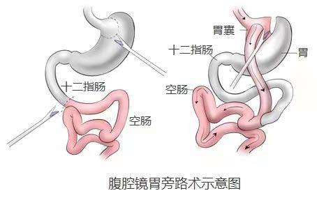 长江云|长江云：过度肥胖带来一身病 接受减重手术：330斤“重磅小伙”一月减掉50斤