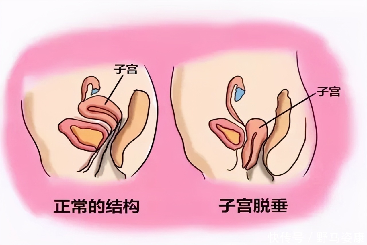 月子|产妇顺产半个月后,身体排出“一块肉”,检查结果显示要切除子宫