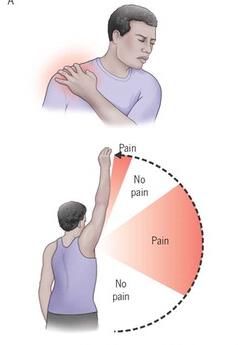 肩峰|“肩痛治疗走了弯路”，医学博士告诉你这种既省钱又实用的方法
