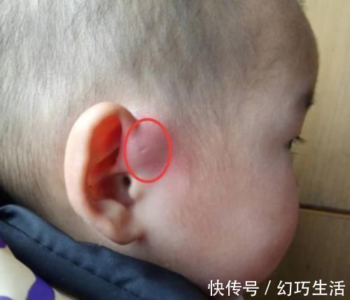 宝妈|为啥有些新生儿耳朵有小孔?医生一般不会主动讲,家长心里要有数