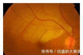 栓塞|爱美妈妈经常做的玻尿酸隆鼻,儿子才做1次竟然就“栓塞”了?