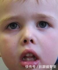 孩子|用嘴呼吸会变丑?父母看到宝宝用嘴呼吸要即使制止!