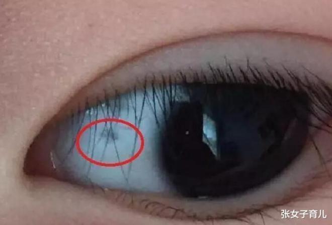 医生|3岁宝宝眼白出现黑点,怎么回事儿听了医生的答案,终于放心了