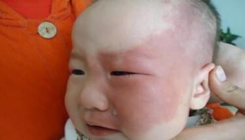 危害|胎记是上帝的吻痕妇产科医生胎记形成的原因和危害,你得知道