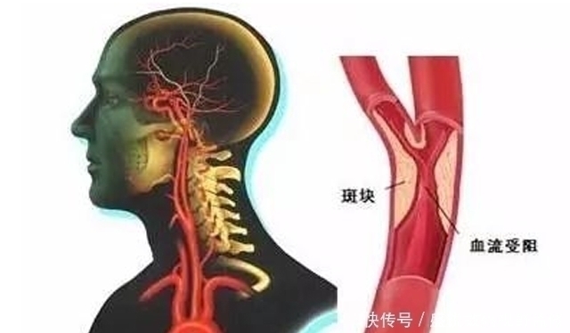 姬松|脑部供血不足,如少做2件事,养成3习惯,脑血管或可干净畅通