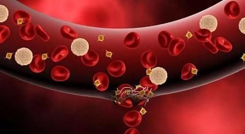 栓塞|血管中藏有血栓的人,睡觉时,会有3种迹象,若占1个,尽快查一下