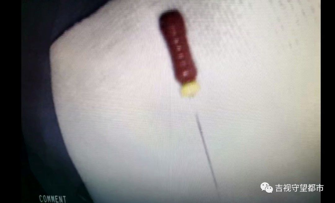 消化道|牙修一半针没了！胃内发现修牙针...