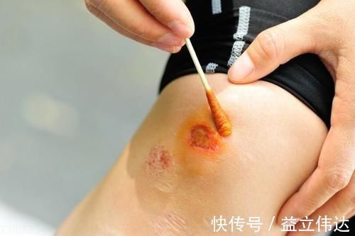 受伤|受伤后伤口发痒难忍受,是怎么回事?应该怎么缓解?