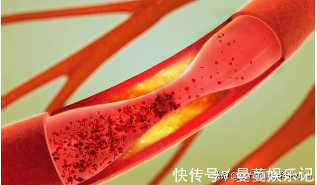 降脂|既能抗凝又能降脂稳定斑块？聊一聊常用的中成药——通心络胶囊