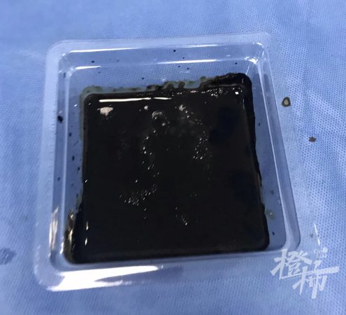 巧克力囊肿|23岁姑娘例假不规律！吃了止痛片还是痛得死去活来