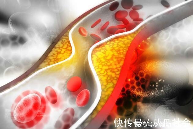 高血脂患者|血脂高先别慌,坚持做好这5点,血脂慢慢往下降,不妨试试