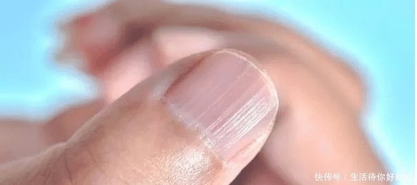 遗传|手指甲出现“竖纹”, 多半和这3个“情况”有关, 看完或许会明白!