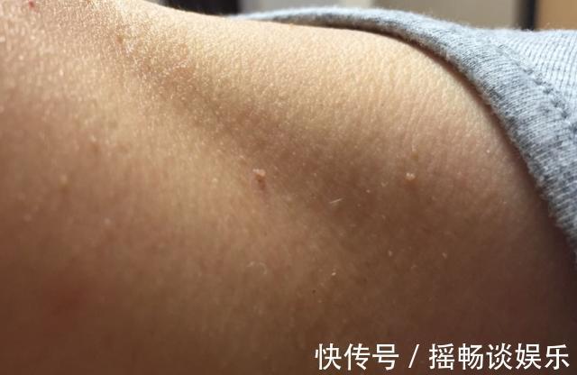 晨晨|19岁女大学生感染HPV,肉芽疙瘩遍体,医生:80%就诊的都是大学生