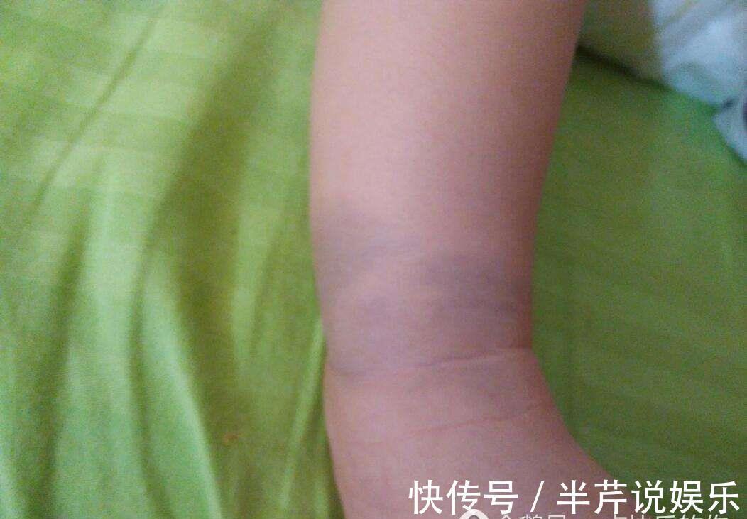 投胎|胎记是投胎时阎王爷打的吗答案可能令你想不到