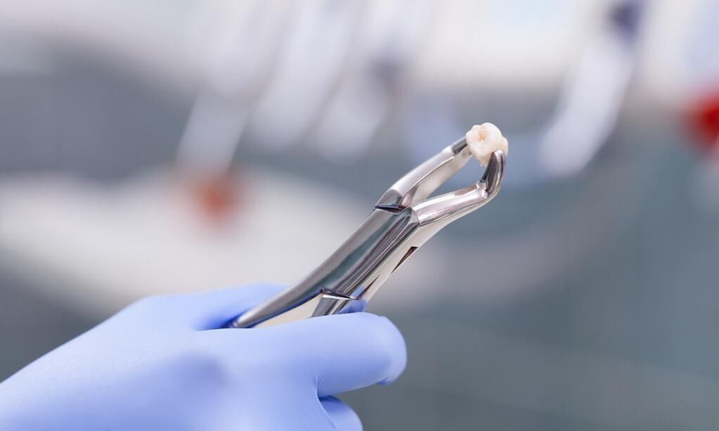 植物人|拔牙拔成植物人!高血压患者到底还能不能拔牙?专业医生有话说