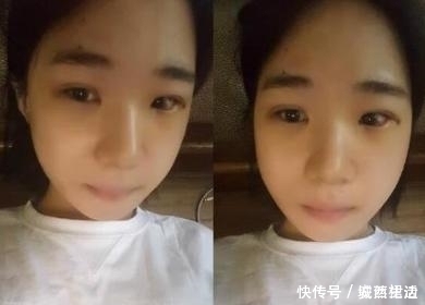 小脸|小脸确实更可爱,看完整容过程,只觉得满屏的疼痛