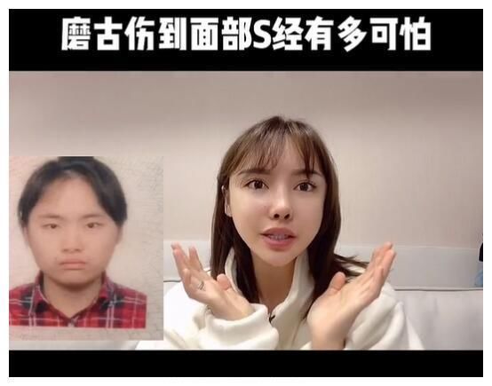 真实颜值|美女网红花70万却整形失败,磨骨伤到神经毁容,自叹非常后悔