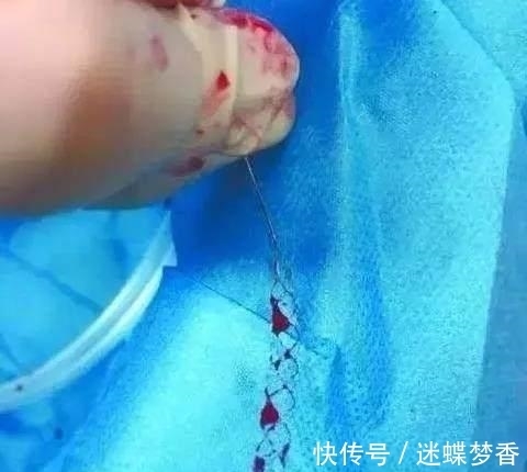 凝血因子|中风的“罪魁祸首”是血栓, 记牢两个字血栓不上身