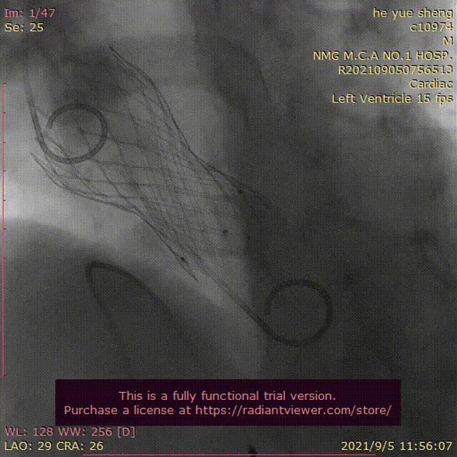 医院|医院心脏大血管外科成功完成一例PCI+TAVR“一站式”手术