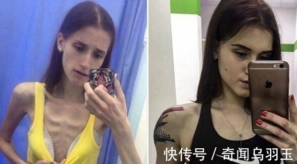 ver18岁少女患厌食症,体重只有63斤,如今却成为了性感女教练
