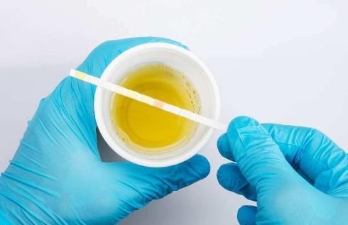 男人|男人晨起后，“第一泡尿”若没有3个现象，恭喜，肾脏比较强壮