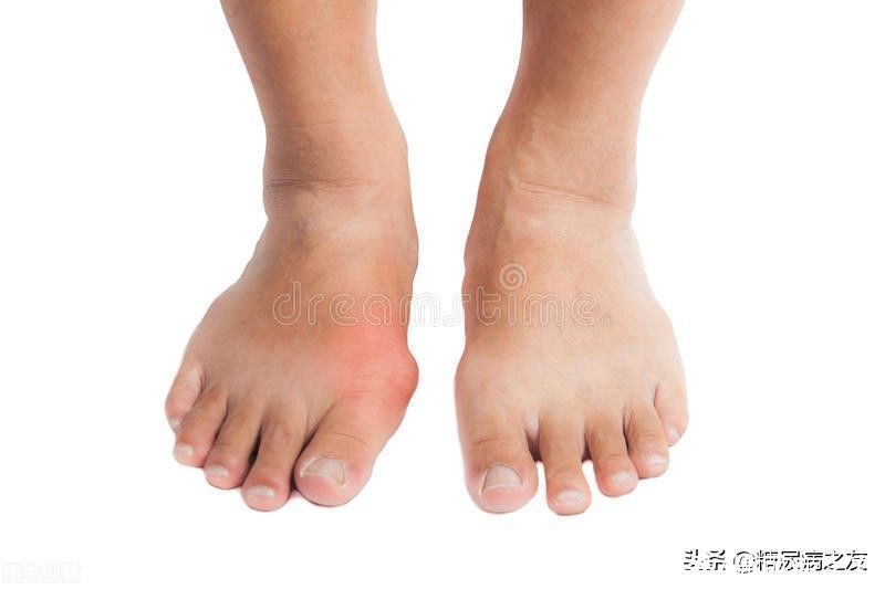 痛风病人|尿酸高痛风，不喝一种汤，可喝一种饮品