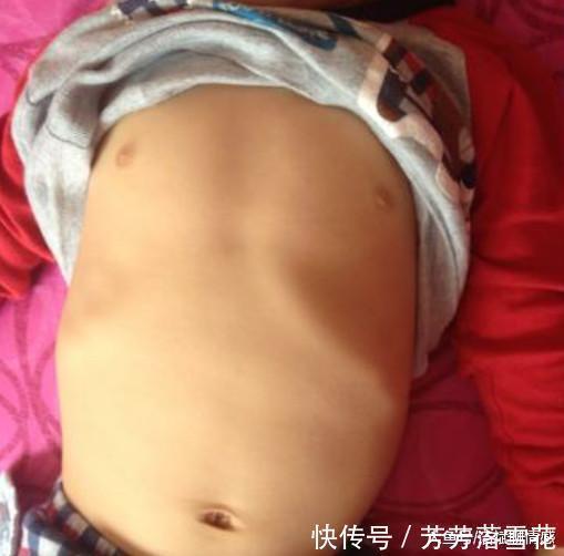 维d|“鸡胸”宝宝越来越多, 到底该怎么做才能预防这种情况的发生