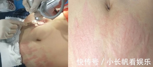 孕期|生个孩子“肚皮开花”,孕期做好掌握这3点,妊娠纹离你远远的