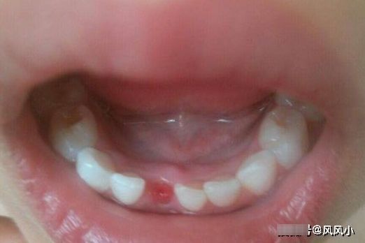 区别|孩子几岁开始换牙,属于发育正常?男孩和女孩有什么区别?