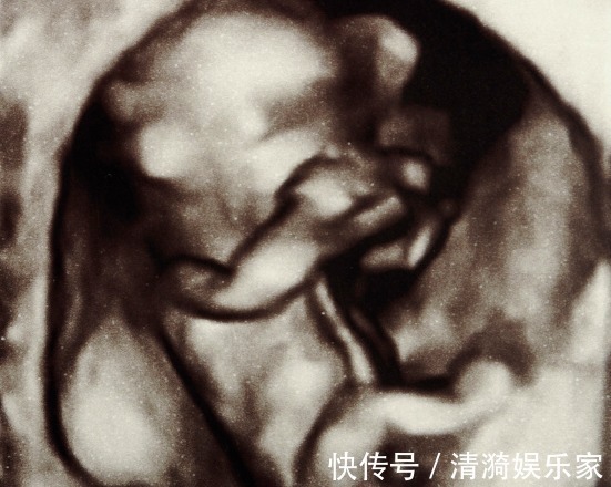 产检|前几次产检没问题,孕晚期却查出胎儿畸形,过了这个阶段才能放心