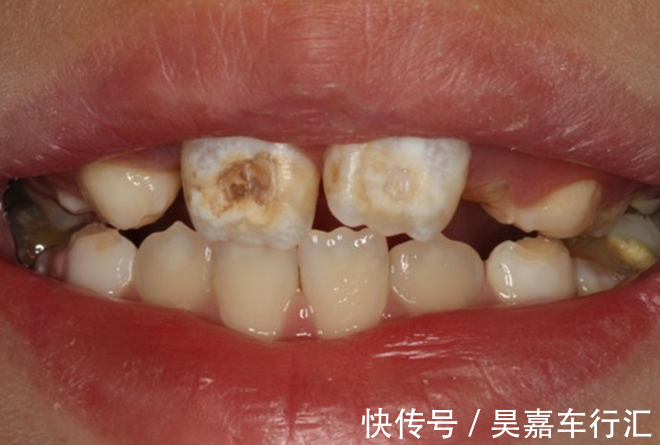 家长会|让孩子“烂牙”的不是糖,是家长无知!3种错误行为,一定要避免