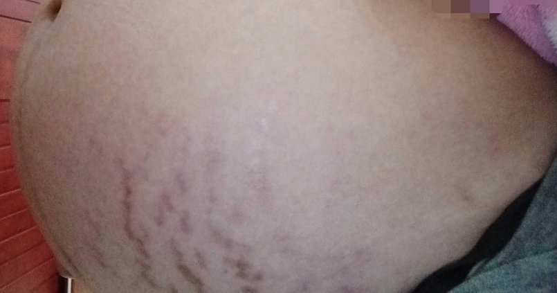 怀孕|怀孕7个月的孕妈每天抹油,但还是长了妊娠纹,医生的一句话扎心了