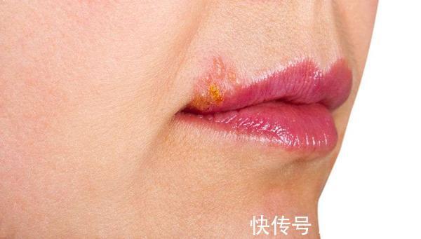 疾病|体内有病,嘴巴告知?嘴唇出现5种迹象,或疾病信号,希望别大意