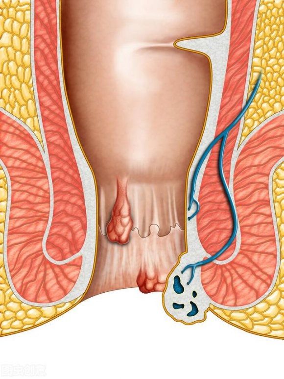遗传史|看着光鲜亮丽，也许是有痔青年！痔疮4大祸根，希望你一样都不占
