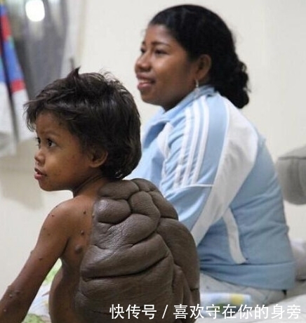 国外一8岁男孩从小身患怪病，每天背着”龟壳“出门