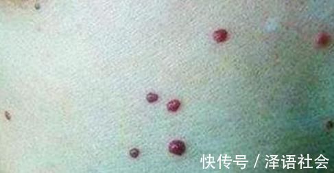 红痣|身上突然长了很多小红痣，是什么原因？其中1个需警惕，不可忽视