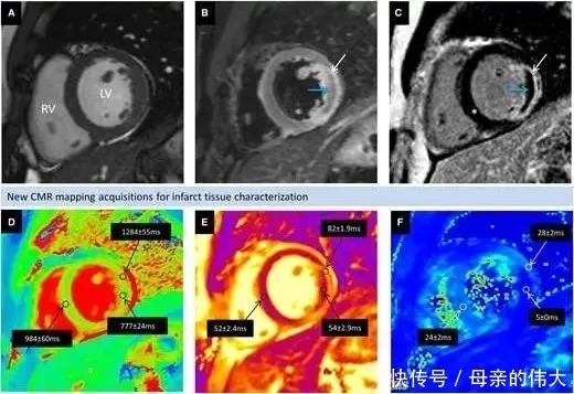 乳腺癌|同时被糖尿病和乳腺癌,折磨的女白领,含泪讲述哪个更威胁生命?