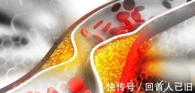 梓醇|中风的“罪魁祸首”是血栓, 记牢两个字血栓不上身