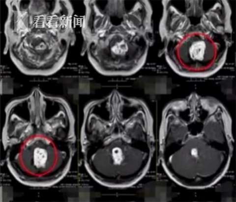 阿姨|阿姨脖子酸痛以为是颈椎病 一查发现竟长了肿瘤